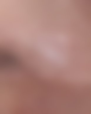 치료 후 사진 (로그인 후 열람)