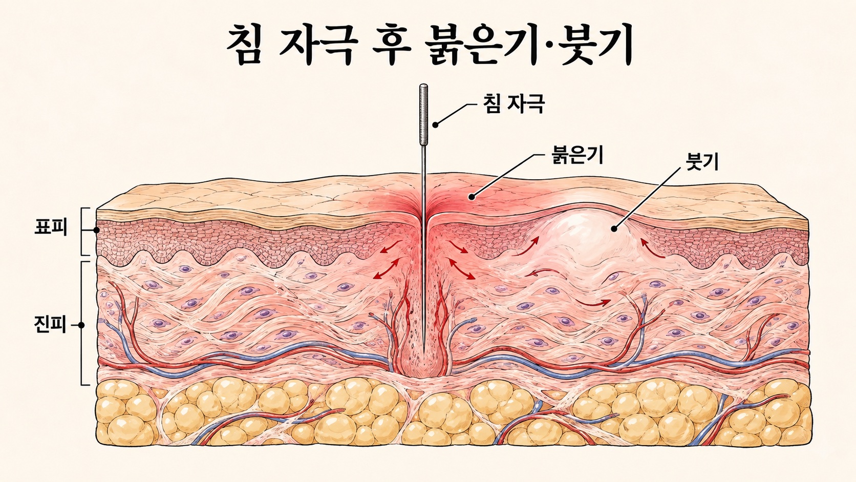 침 자극이 지나간 자리에서 혈류로 인한 붉은기와 체액으로 인한 붓기가 나타나는 피부 단면 구조