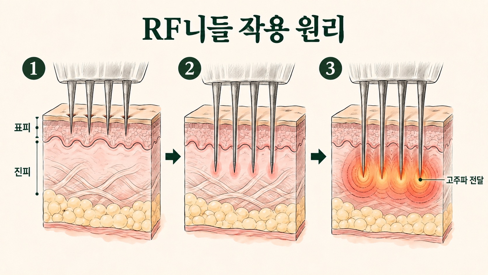 가는 니들이 표피를 지나 진피층에 도달해 고주파를 전달하는 RF니들 작용 원리